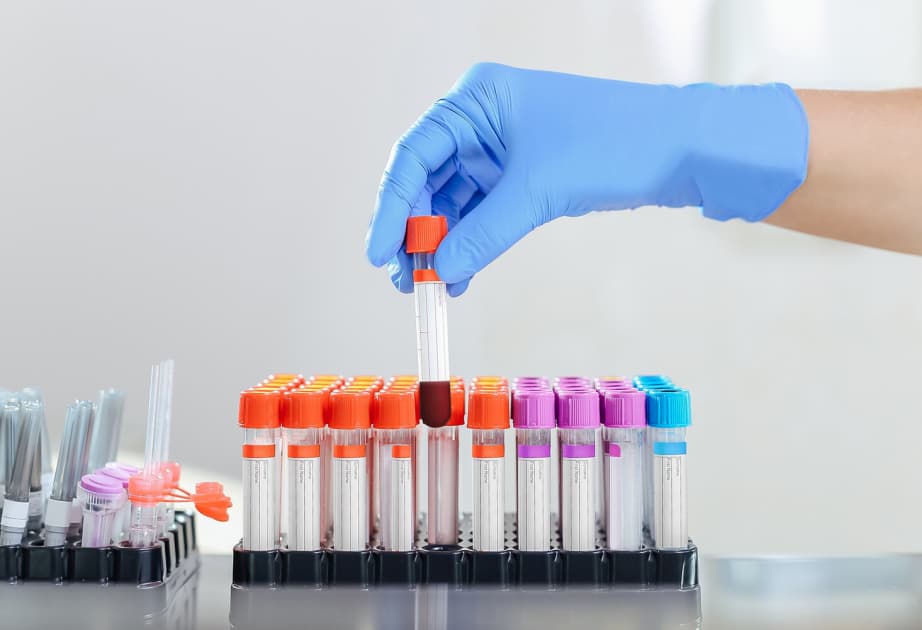 Bir damla qanla xərçəngin diaqnostikası üçün yeni test hazırlanıb