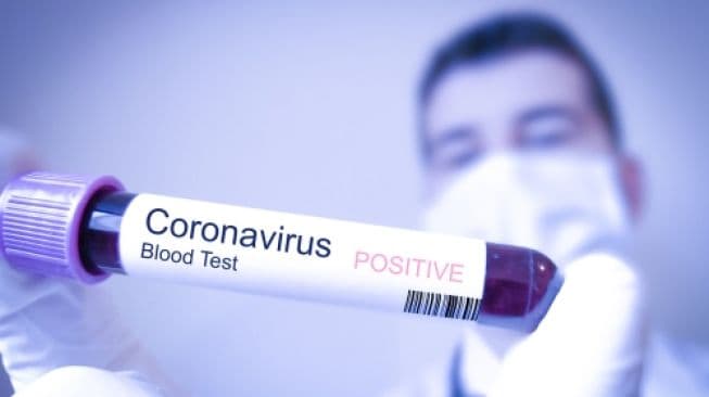 Azərbaycanda daha 9 nəfərdə koronavirus aşkarlandı