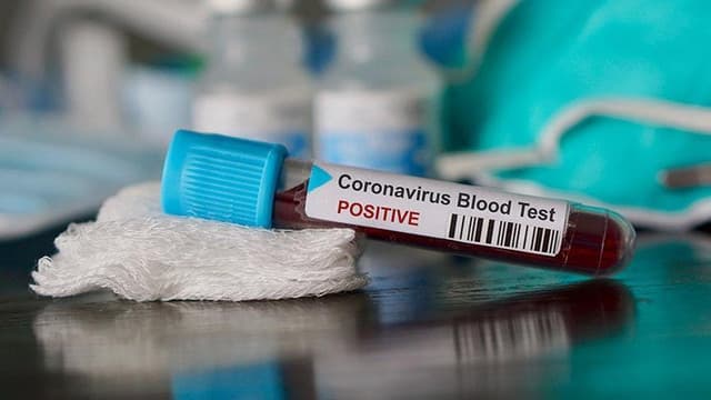 Azərbaycanda 29 yeni koronavirus yoluxması qeydə alınıb, 1 nəfər ölüb - RƏSMİ