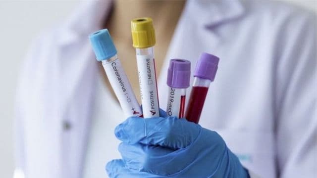 Koronavirusa yoluxanların sayı dünənə nisbətən artıb – STATİSTİKA