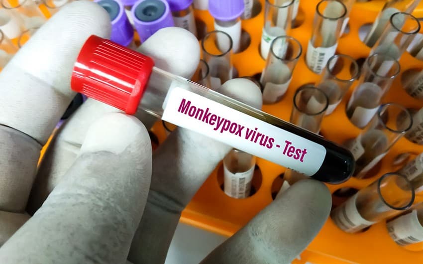 Azərbaycan ÜST-dən meymunçiçəyi test dəstlərini təhvil alıb