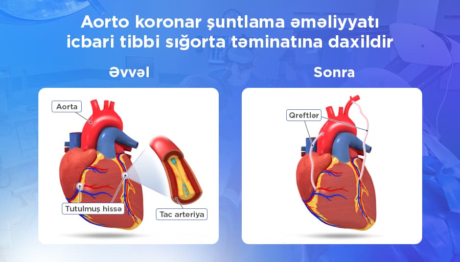 Aorto-koronar şuntlama əməliyyatı icbari tibbi sığorta ilə qarşılanır