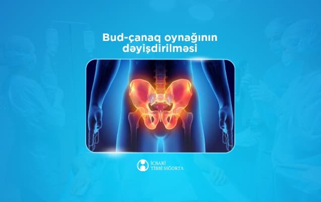 İcbari tibbi sığorta bud-çanaq oynağının süni protezlə dəyişdirilməsi əməliyyatını qarşılayır