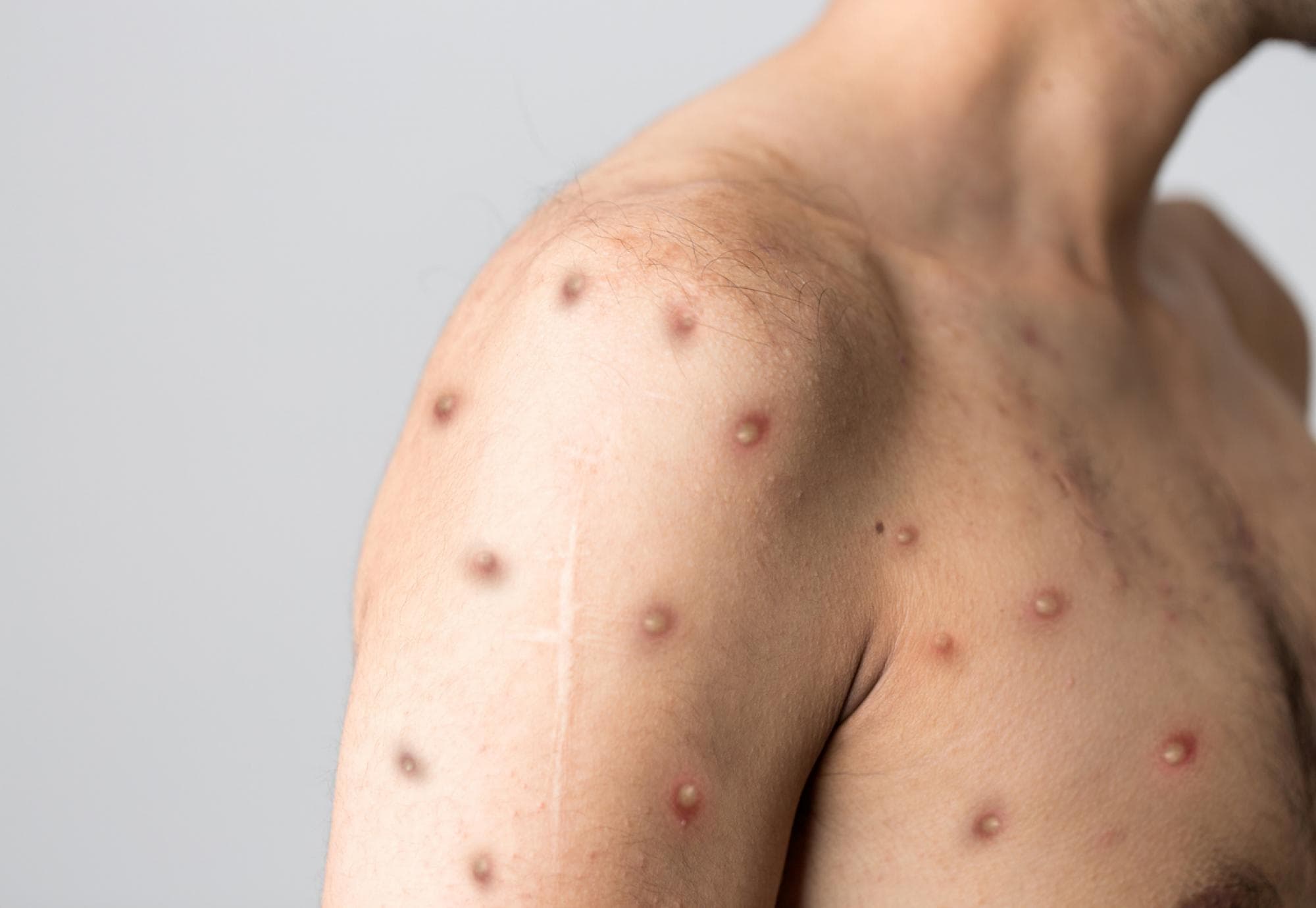 Bu dövlətdədə meymunçiçəyi (mpox) virusu aşkarlandı