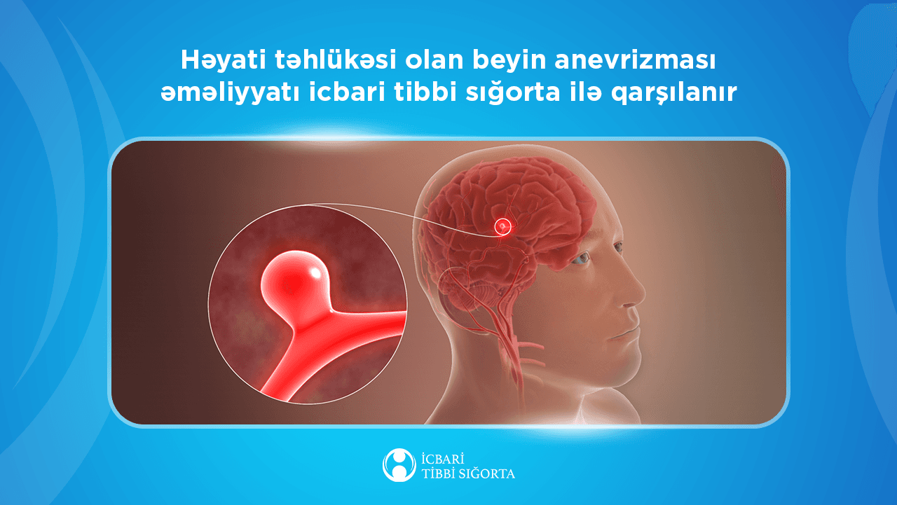 Beyin anevrizmasının müalicəsisığorta ilə qarşılanır