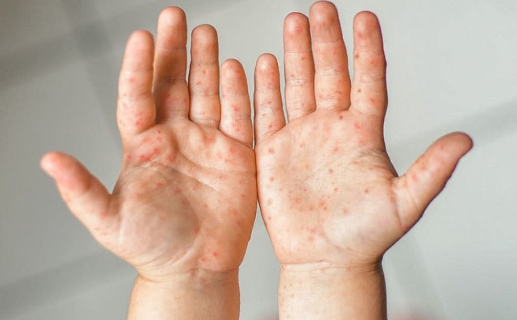Kanada ən böyük qızılca epidemiyasını qeyd edir