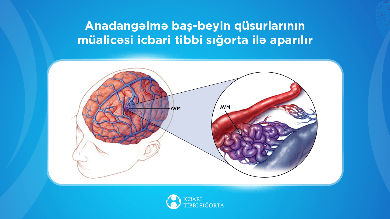 AVM əməliyyatları icbari tibbi sığorta ilə qarşılanır