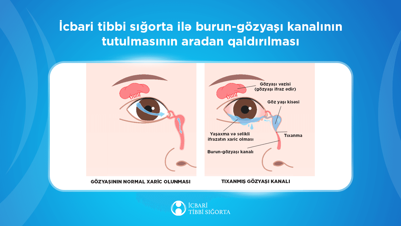 Gözyaşı axarının bərpası əməliyyatı icbari tibbi sığortaya daxildir