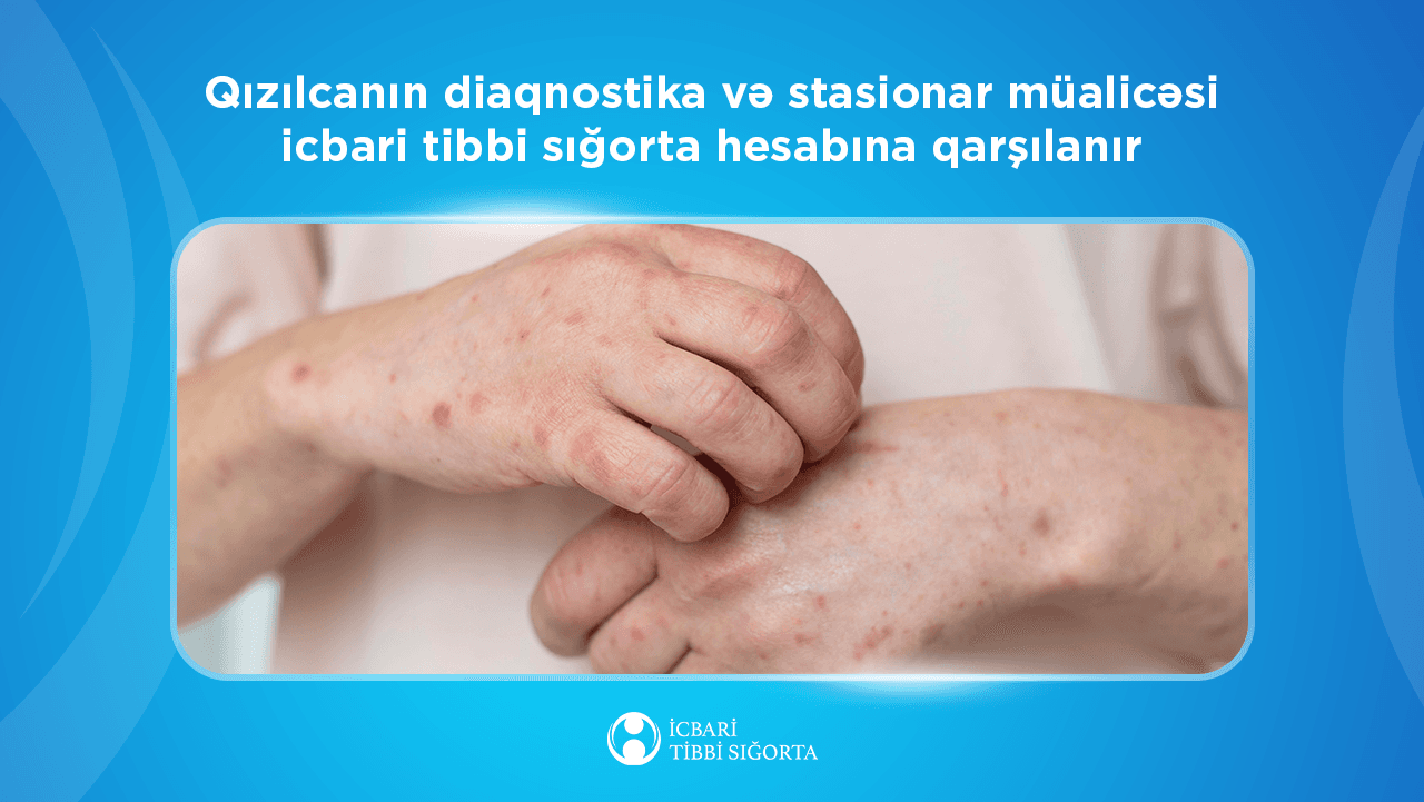 Qızılcanın diaqnostika və stasionar müalicəsi icbari tibbi sığorta hesabına qarşılanır