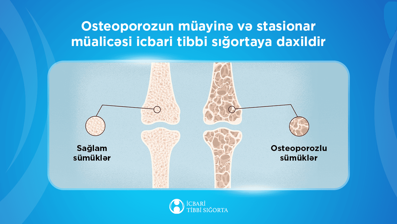 Osteoporozun müayinə və stasionar müalicəsi icbari tibbi sığortaya daxildir