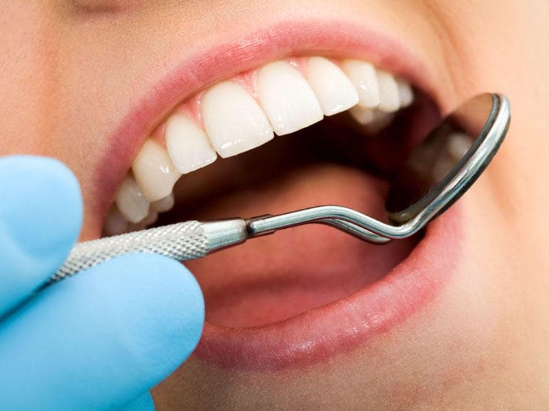 Diş plomblarında inqilabi yenilik: Bioaktiv şüşə bakteriyaları 61% azaldır