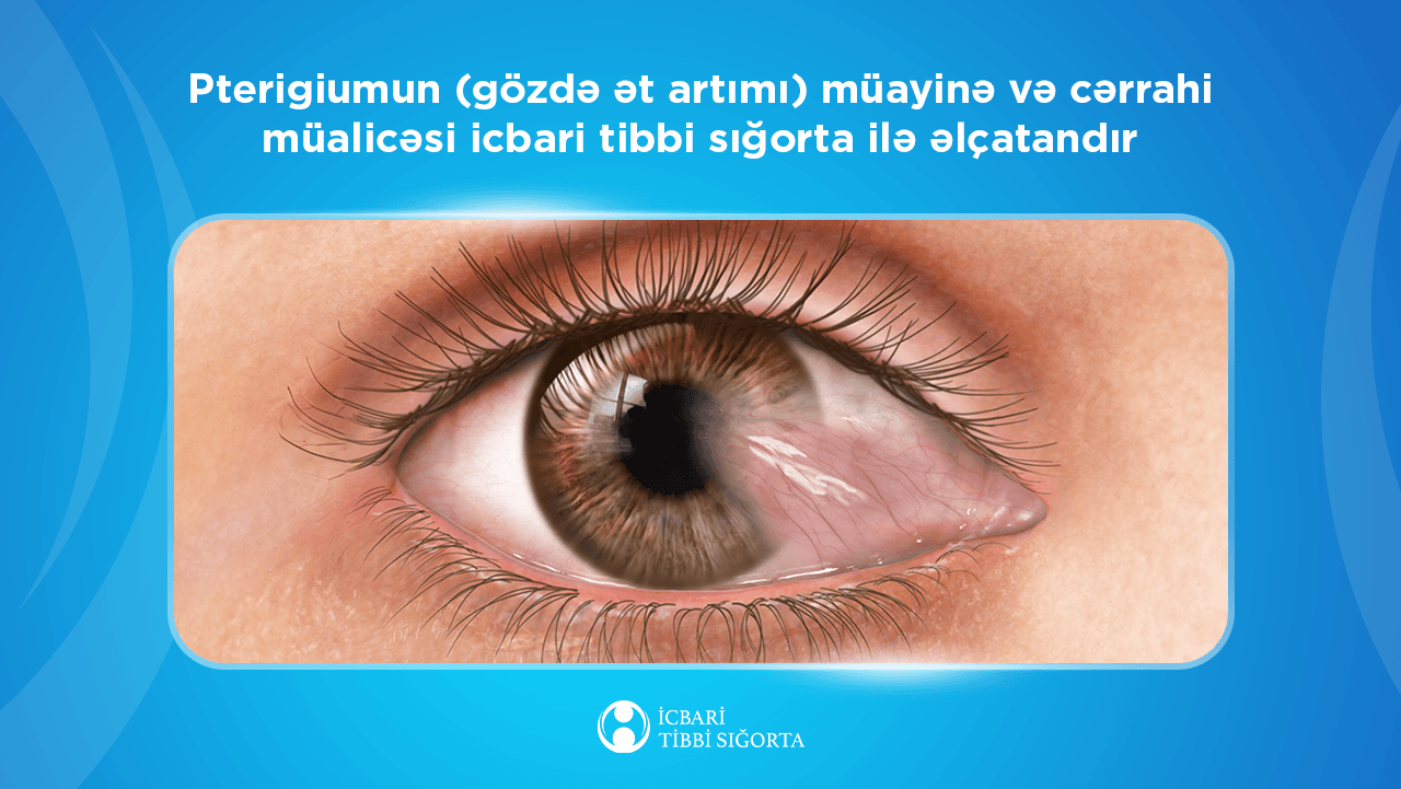 Ötən il ərzində icbari tibbi sığorta hesabına 2192 sayda gözdə ət artımı əməliyyatı icra olunub
