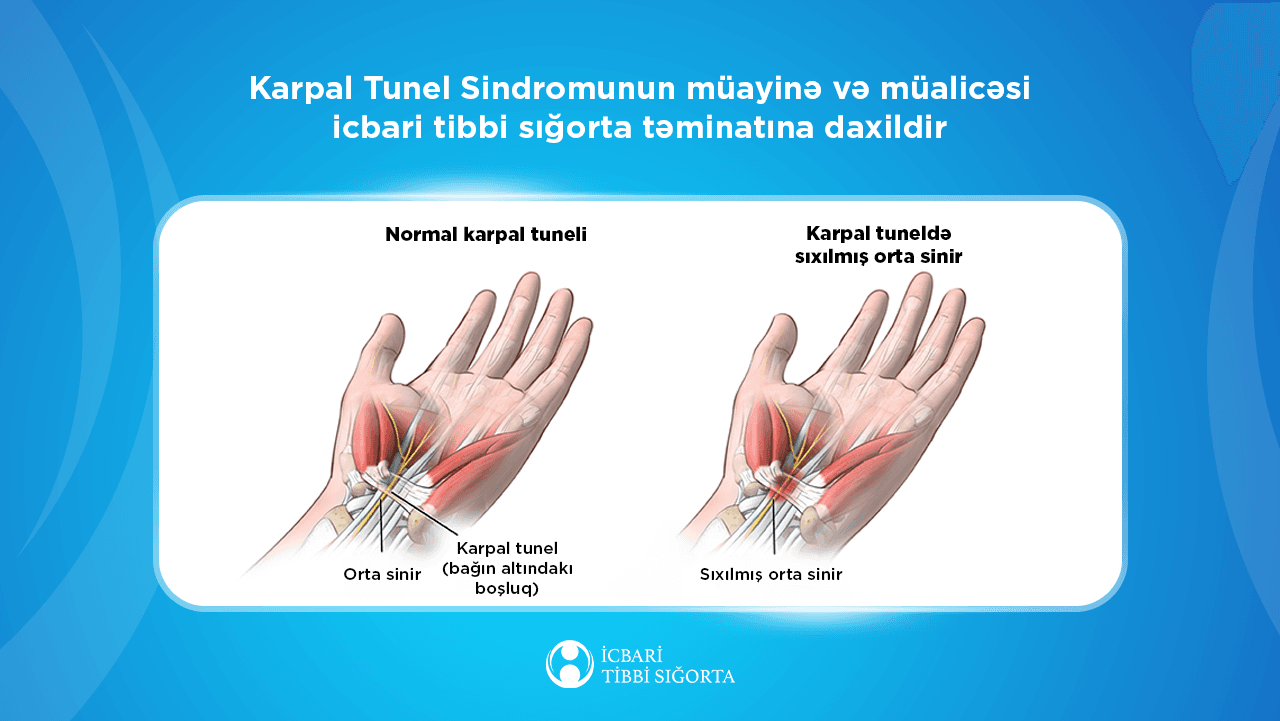 Karpal Tunel Sindromunun müayinə və müalicəsi icbari tibbi sığorta təminatına daxildir