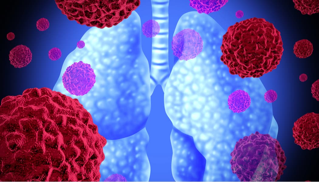 Kiçik hüceyrəli olmayan ağciyər xərçəngi: səhər saatlarında immunoterapiya daha effektivdir