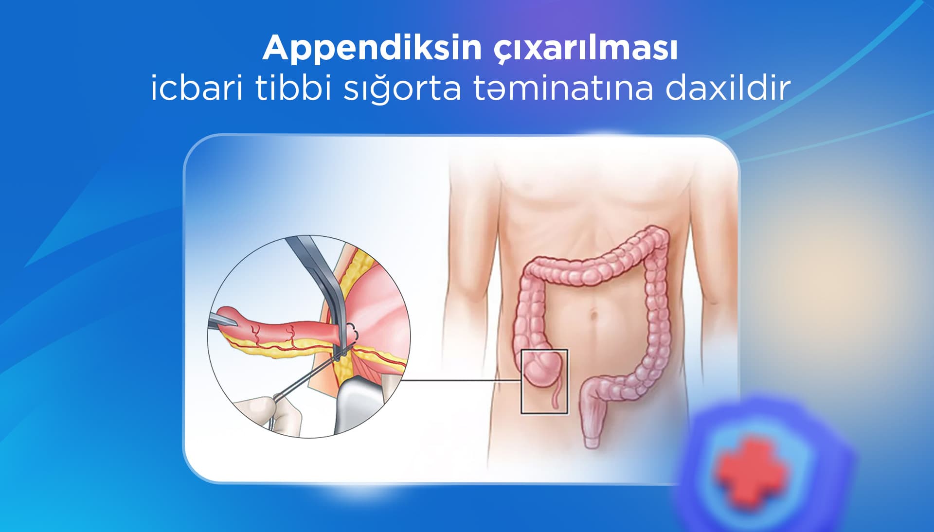 2021-ci ildən bu günədək icbari tibbi sığorta ilə 17 671 appendektomiya icra olunub 2021-ci ildən bu günədək icbari tibbi sığorta ilə 17 671 appendektomiya icra olunub
