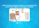 Sidik-ifrazat sisteminin katerizasiyası icbari tibbi sığorta təminatına daxildir - İTSA