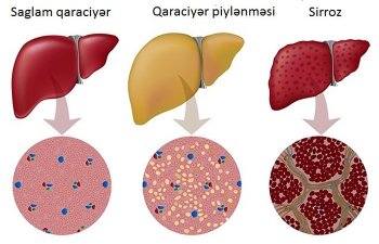 Qaraciyər xəstəlikləri: sirroz, hepatit, piylənməyə qarşı- GÜCLÜ RESEPT