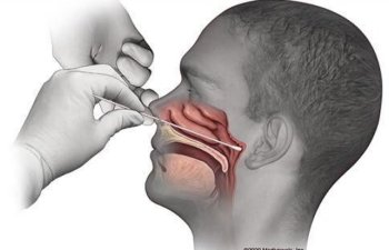 Koronavirus analizi belə götürülür – Ağrılı prosesdir