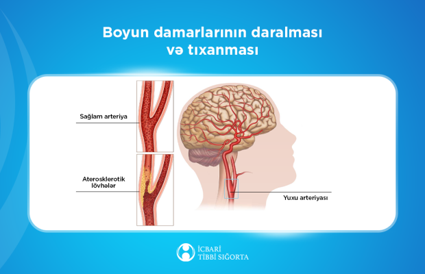 İcbarı tibbi sığorta ilə beyin qan dövranı pozulmalarının müalicəsi artıq mümkündür